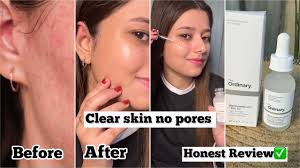 Buy 1 Get 1 Free Ordinary Niacinamide 10% + Zinc 1% 30ml